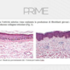 Collagene Eterologo Di Tipo I – Biostimolazione Cutanea