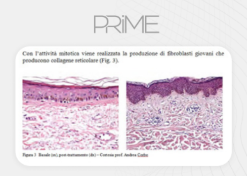 Collagene Eterologo Di Tipo I – Biostimolazione Cutanea